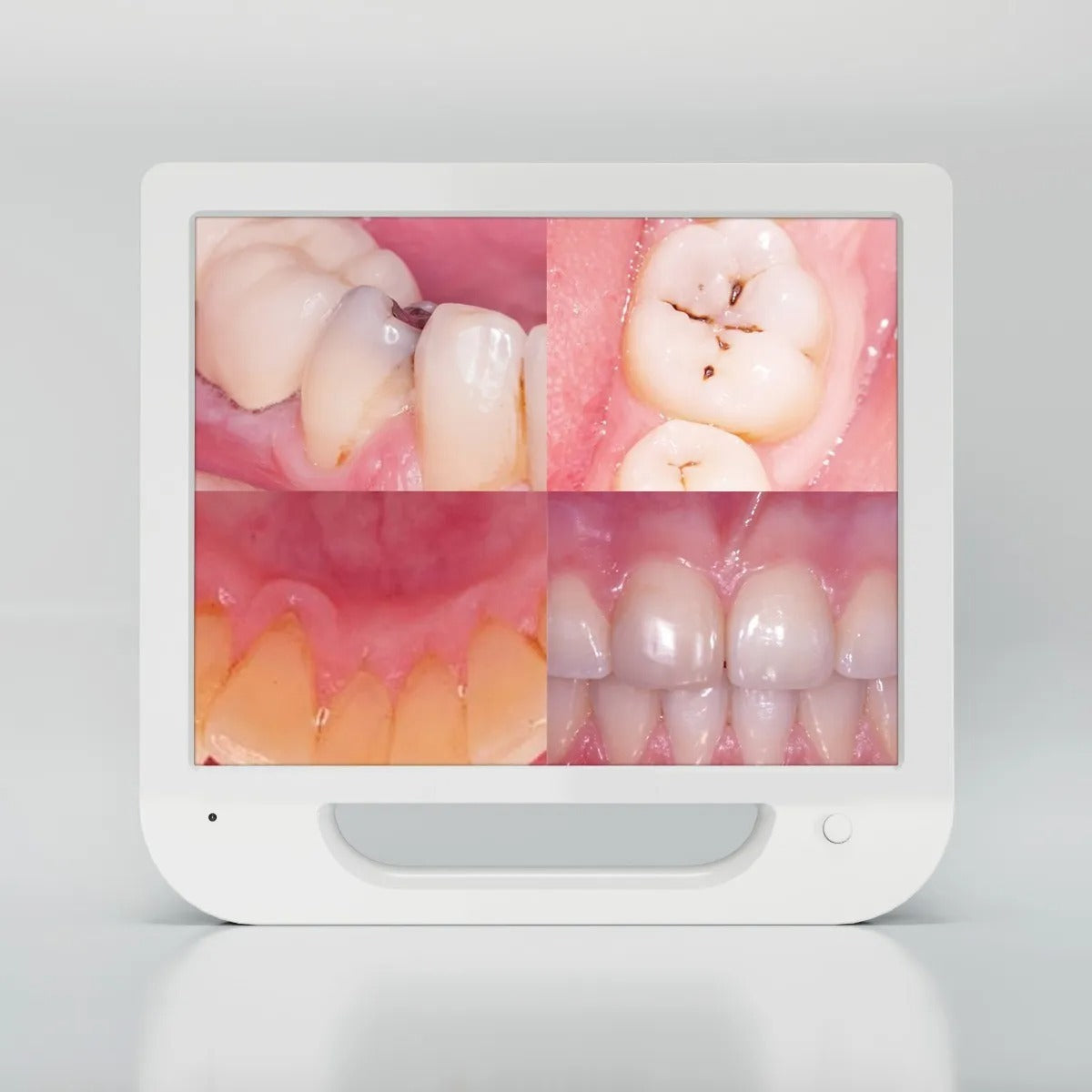 Advanced Intraoral Camera System for Dentistry: High-Resolution Mouthwatch Dental Camera with LED Lighting and 17-Inch Screen